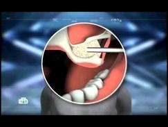 Зубные импланты: правда и вымысел